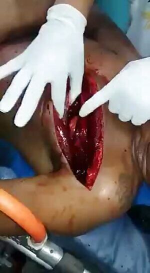 Man's chest cut open with machete