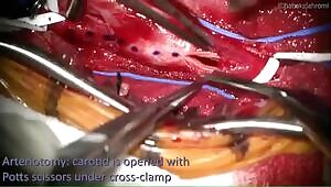 Removing plaque from a blocked carotid artery