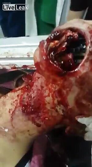 A large metal shrapnel goes through a person's head, and is still luckily alive!