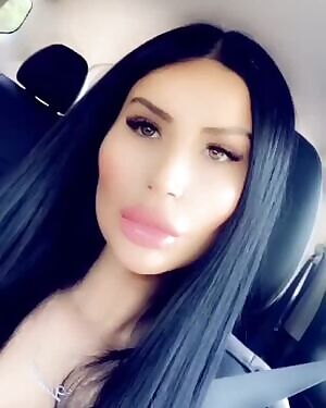 Fresh fillers and botox