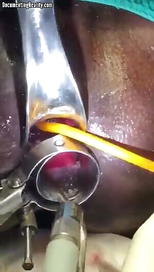 Surgeon's remove a Thumbs Up Cola bottle from a patient's anus