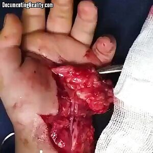 Pulse can be seen inside severely damaged hand at the ER